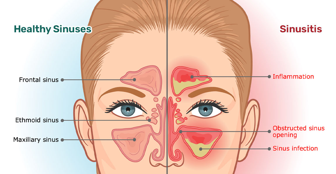 Sinus Infection | Luke Tan Center
